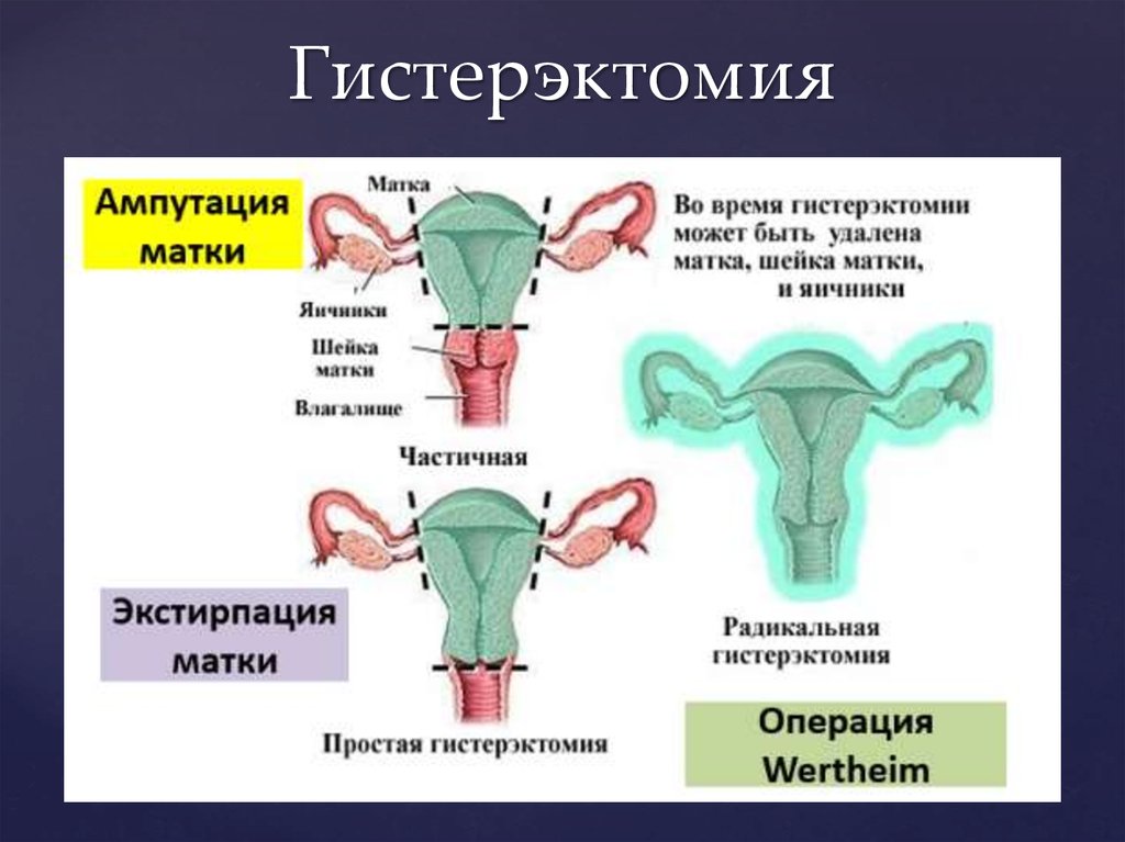 Операция женских матка. Экстирпация матки ампутация матки отличия. Энергосберегающая расширенная экстирпация матки с придатками. Влагалищная тотальная гистерэктомия. Ампутация матки матки отличия.