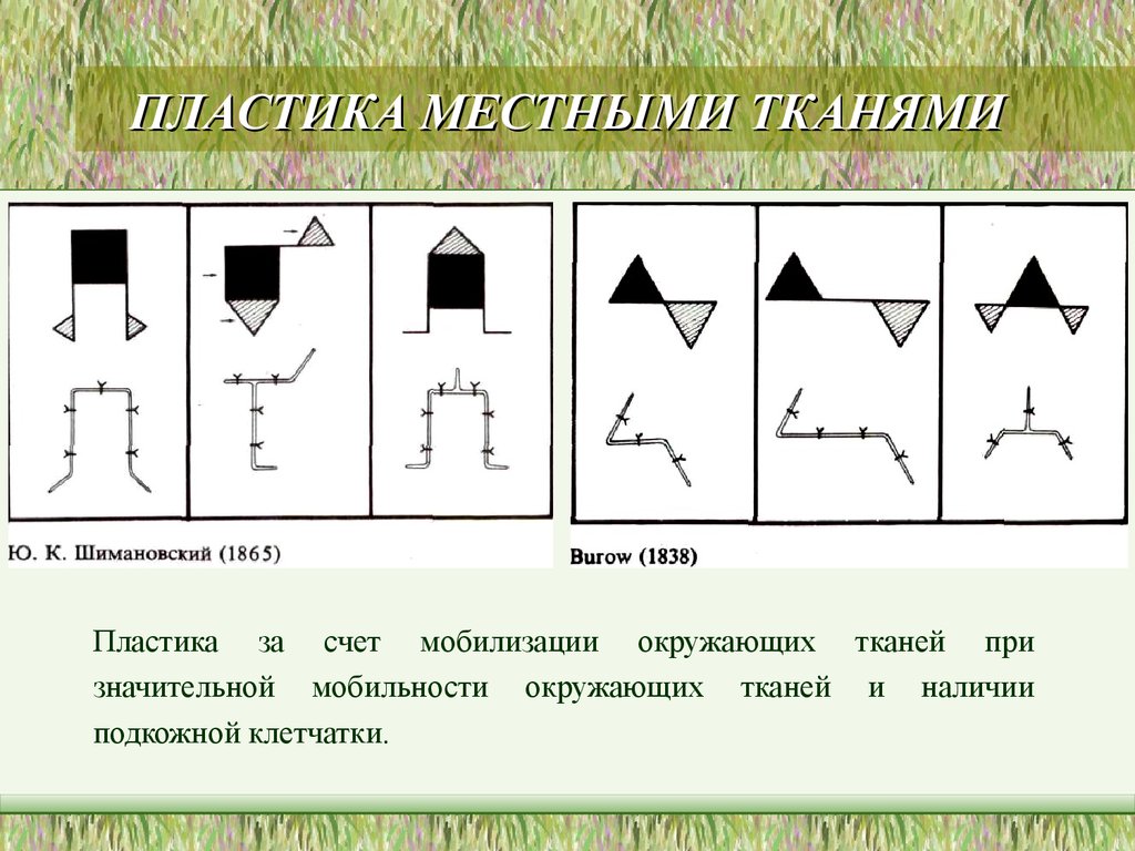 Местная пластика. Пластики местными тканями. Методики пластики местными тканями. Пластика местными тканями по Шимановскому. Схемы пластики местными тканями.