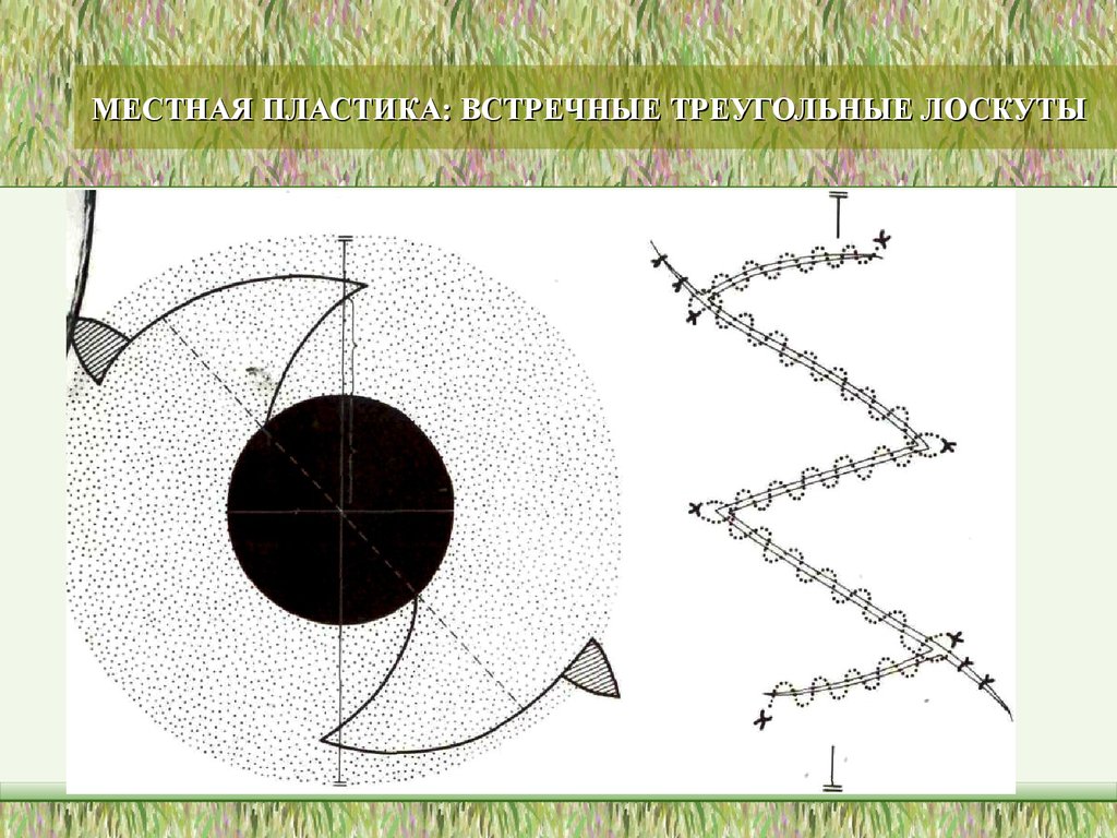 Местная пластика. Пластика встречными треугольными лоскутами по Лимбергу. Пластика встречными лоскутами. Методика пластики встречными треугольными лоскутами:. Местная пластика встречными треугольными лоскутами.