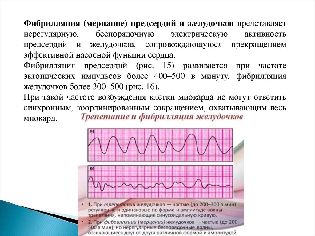 Умеренный ритм миокарда