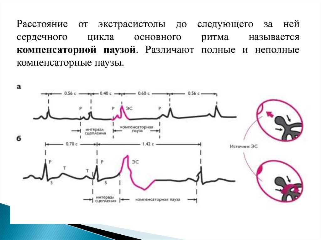 Компенсаторная пауза при экстрасистолии. Компенсаторная пауза на ЭКГ. Нарушение возбудимости сердца. Схема экстрасистолы и компенсаторной паузы.