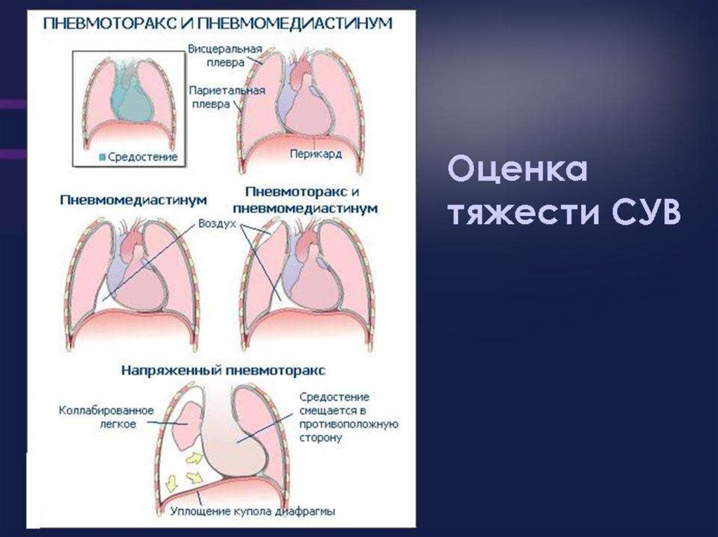 Висцеральная плевра. Пневмоторакс и пневмомедиастинум. Париетальная плевра. Париетальная и висцеральная плевра. Пневмомедиастинум новорожденного.