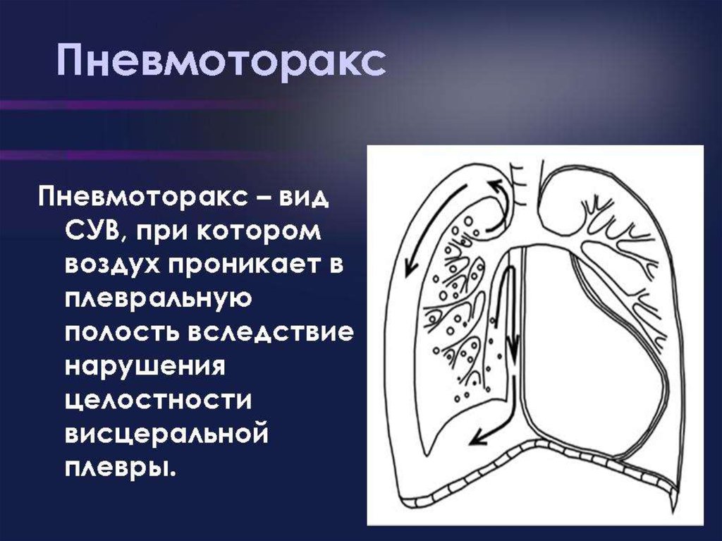 Синдром утечки. Респираторные нарушения. Синдром утечки воздуха у новорожденных. Транзиторное тахипноэ. Транзиторное тахипноэ новорожденных.