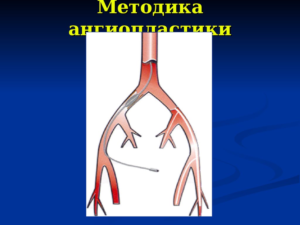 Поражение артерий. Поражения артерий моста. Тандемное поражение артерий.