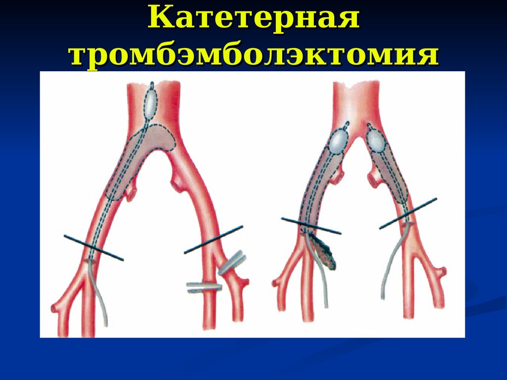 Нарушение артерия. Тромбэмболэктомия способы. Флеботромбоз кистей рук.