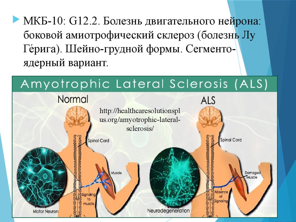 Двигательные заболевания. Болезнь двигательного нейрона. Боковой амиотрофический склероз. Болезнь двигательного нейрона боковой амиотрофический склероз. Боковой амиотрофический склероз шейная форма.