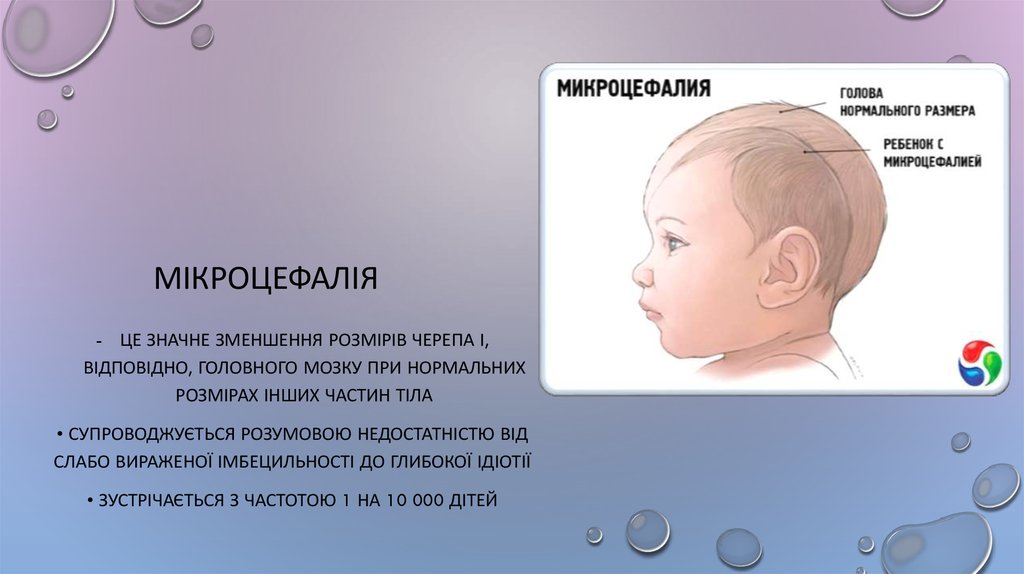 Мікроцефалія