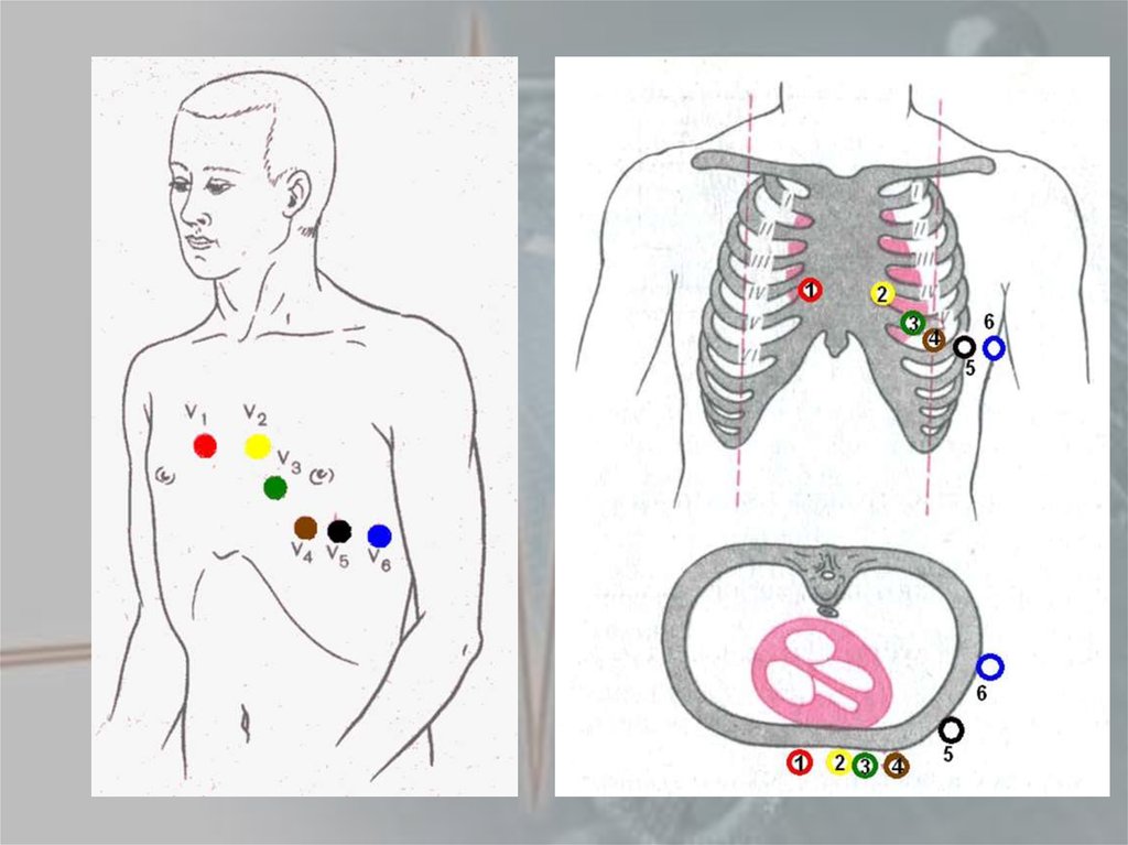 Техника снятия. Алгоритм снятия ЭКГ грудные отведения. Электроды ЭКГ схема наложения электродов. Схема наложения электродов для снятия ЭКГ. Кардиограмма сердца наложение электродов.