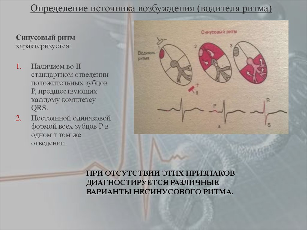 Определение источника возбуждения водителя ритма