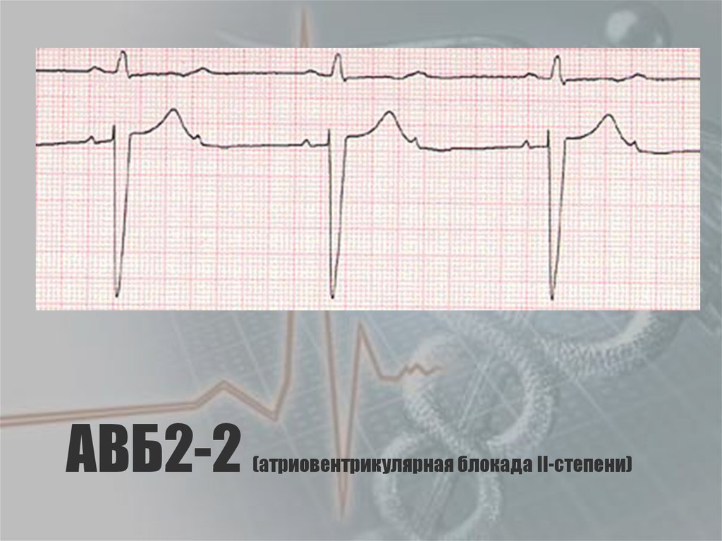 АВБ2-2 (атриовентрикулярная блокада II-степени)
