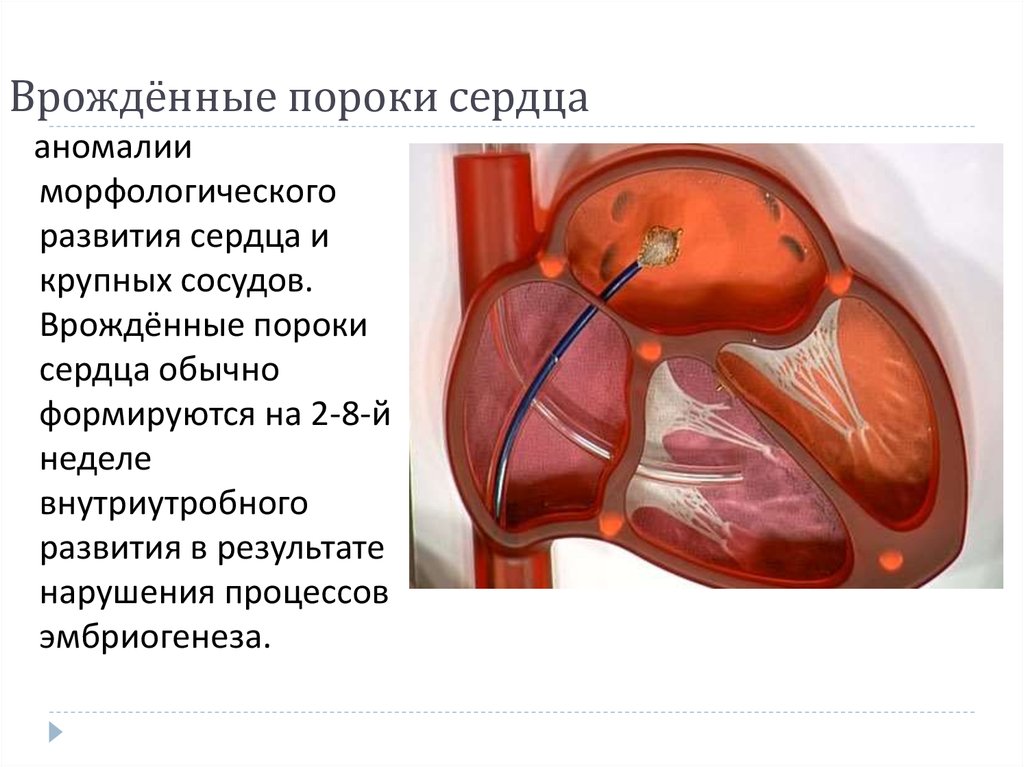 Порок сердца это. ВРАЖДЕНЫЙ порог сердца. Врожденныепопроки сердца. Врождённые пороки ердца.