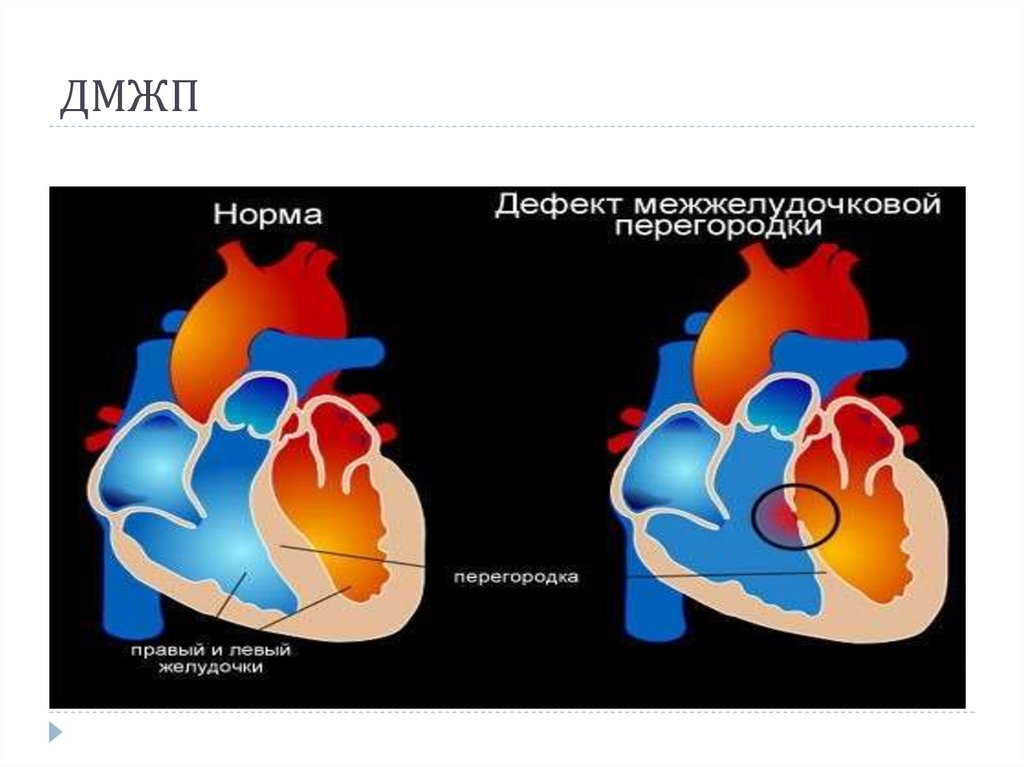 Дефект межжелудочковой перегородки фото