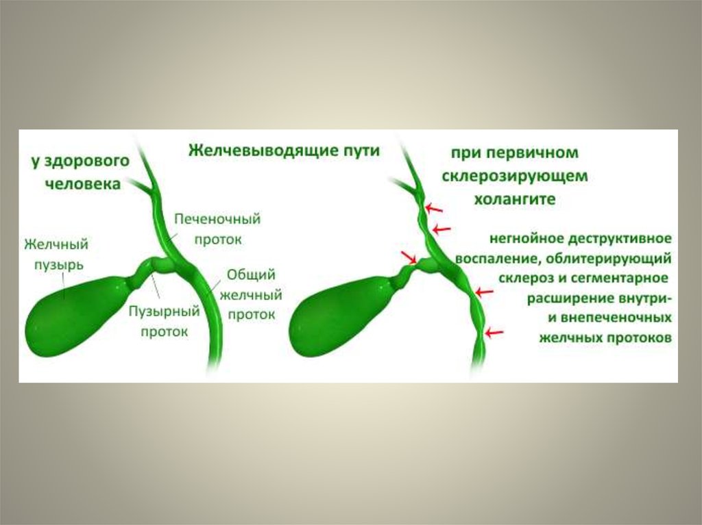 Дискинезия желчного пузыря. Первичный склерозирующий холангит патогенез. Склерозирующий желчный пузырь. Профилактика заболеваний желчевыводящих путей. Холангит желчевыводящих путей.