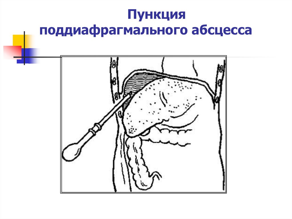 Вскрытие флегмон и абсцессов. Пункция поддиафрагмального абсцесса. Дренирование поддиафрагмального абсцесса. Пункция Гнойного абсцесса. Вскрытие и дренирование абсцесса.