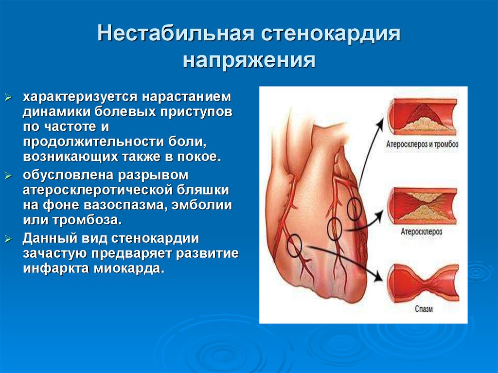 Стенокардия характеризуется. Нестабильная стенокарди. Стенкарди янапряжения. Стенокардия напряжения.