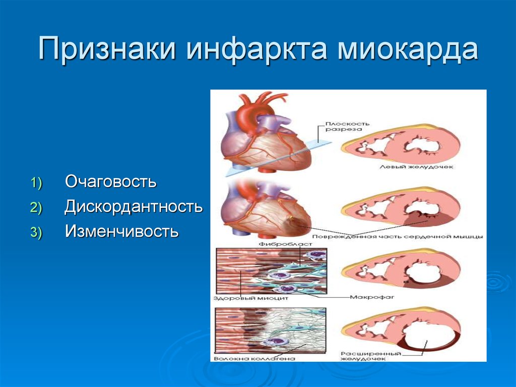 Инфаркт признаки. Основной симптом инфаркта миокарда. Основной симптом инфаркта миокарда (1):. Морфологические проявления инфаркта миокарда. Главный признак инфаркта.