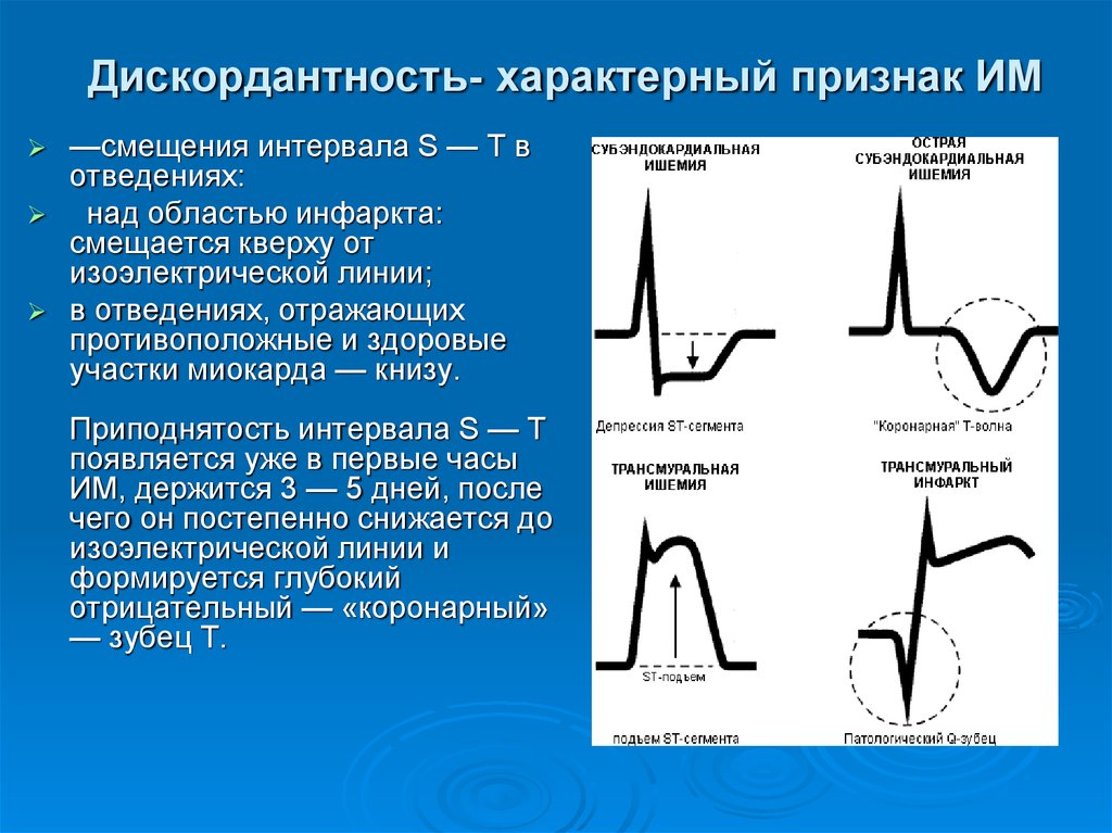 Конкордантный подъем сегмента. Дискордантный подъем сегмента St на ЭКГ. Дискордантные изменения на ЭКГ. Дискордантность это в ЭКГ. Дискордантность сегмента St это.