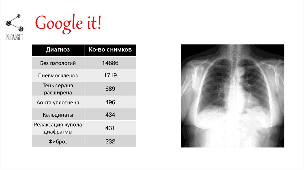 Результаты флюорографии расшифровка. Описание флюорографии. Расшифровка флюорографии. Таблица флюорографии. Флюорография снимок с описанием.
