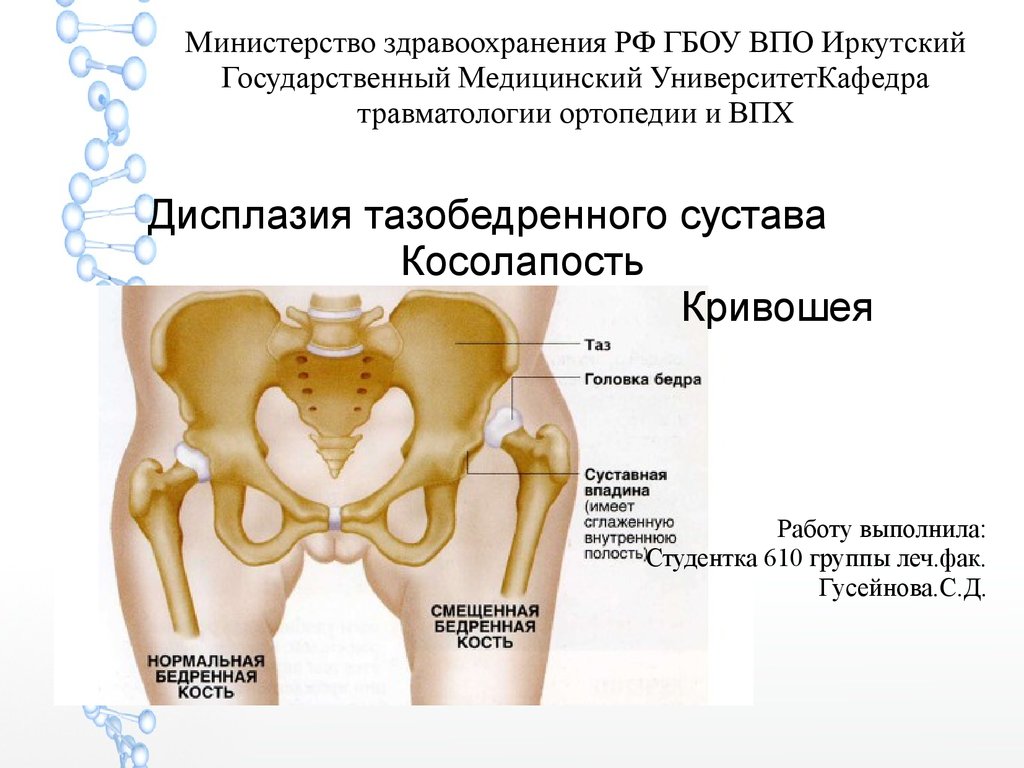 Дисплазия тазобедренного сустава и врождённый вывих бедра