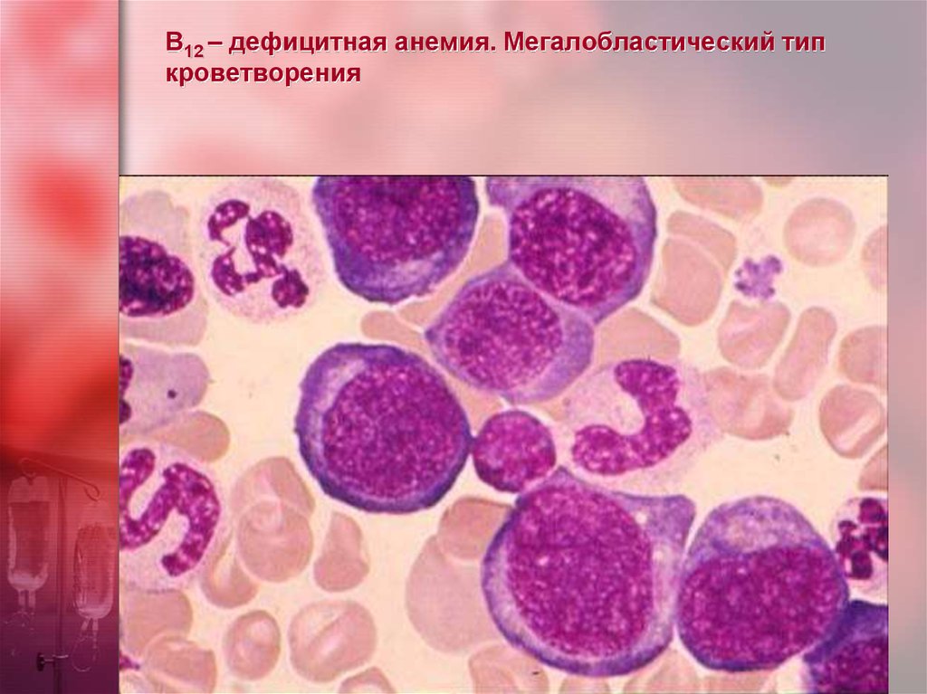 В12 – дефицитная анемия. Мегалобластический тип кроветворения