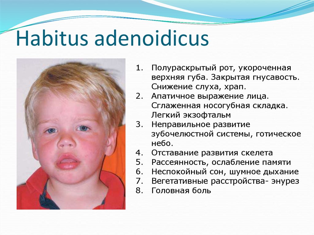 Синдром неживого лица. Аденоидный Тип лица у детей. Аденоидное выражение лица. Формирование аденоидного типа лица.