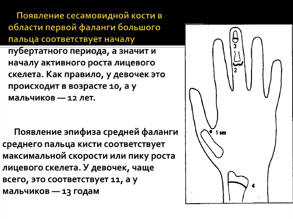 Сесамовидные кости. Сесамовидные кости человека. Сесамовидные кости пястно фалангового сустава. Сесамовидная кость первой фаланги.