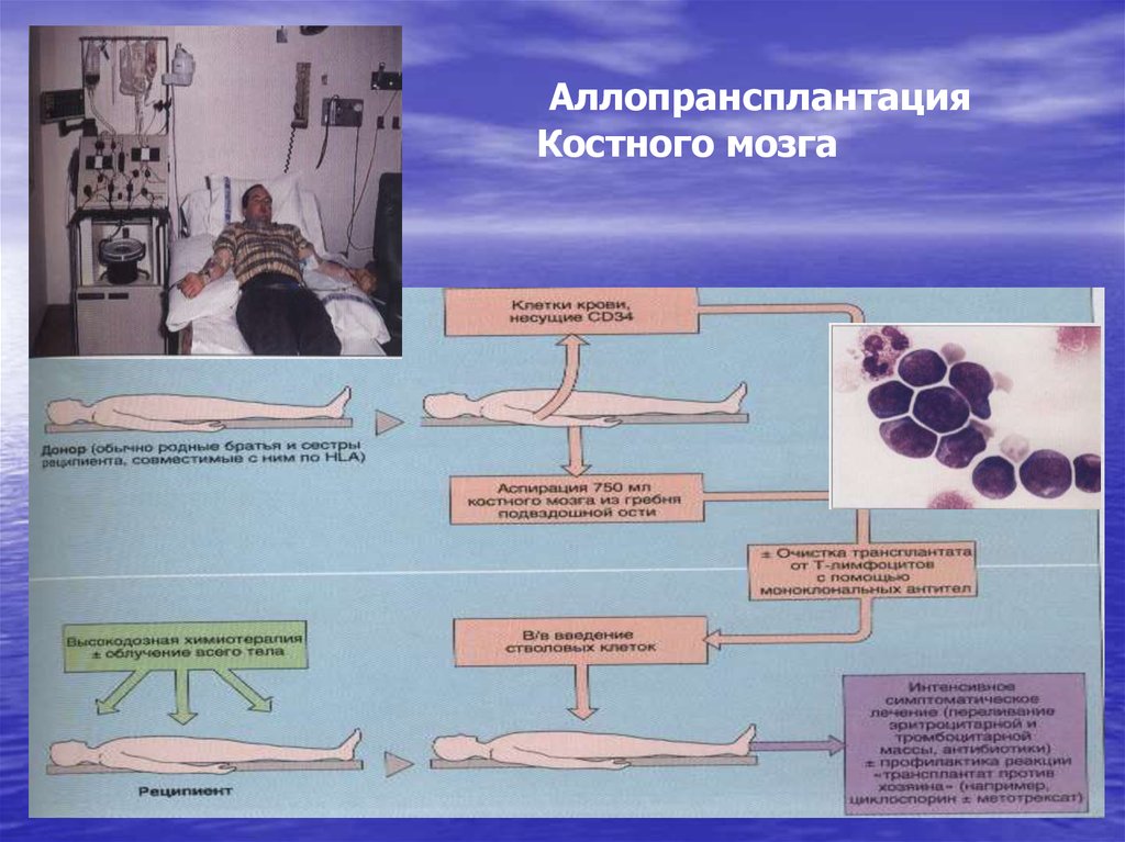 Острый лейкоз презентация по терапии