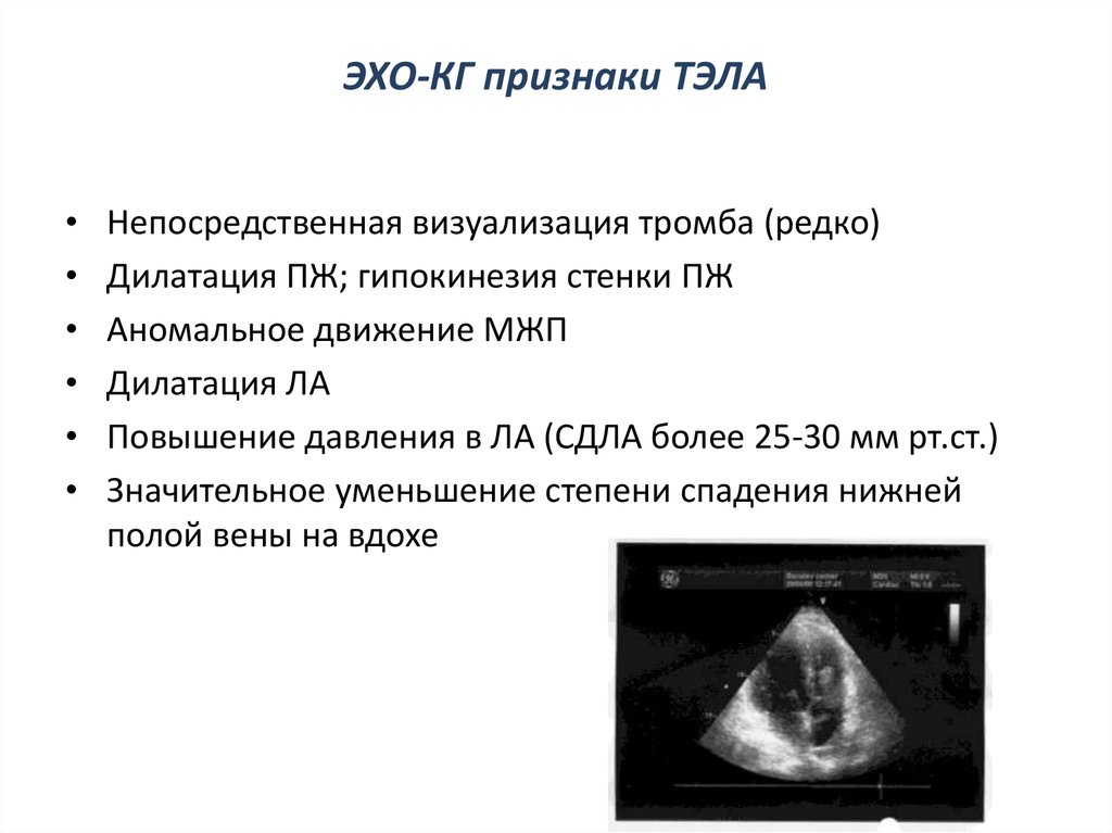 Эхо признаки. Тромбоэмболия легочной артерии на ЭХОКГ. Тэла Эхо кг признаки.