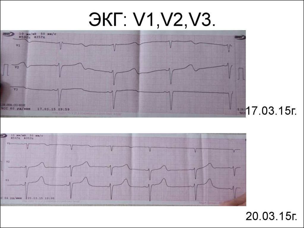 Экг v1 v6