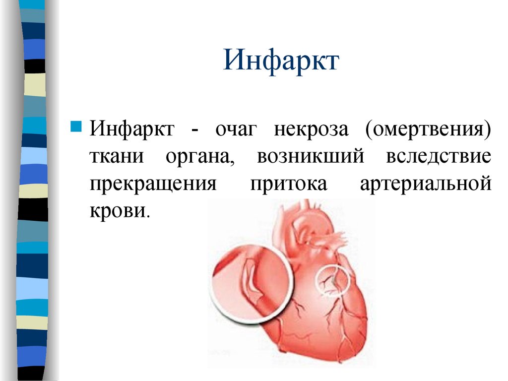 И органов возникает. Инфаркт это в патологии определение.