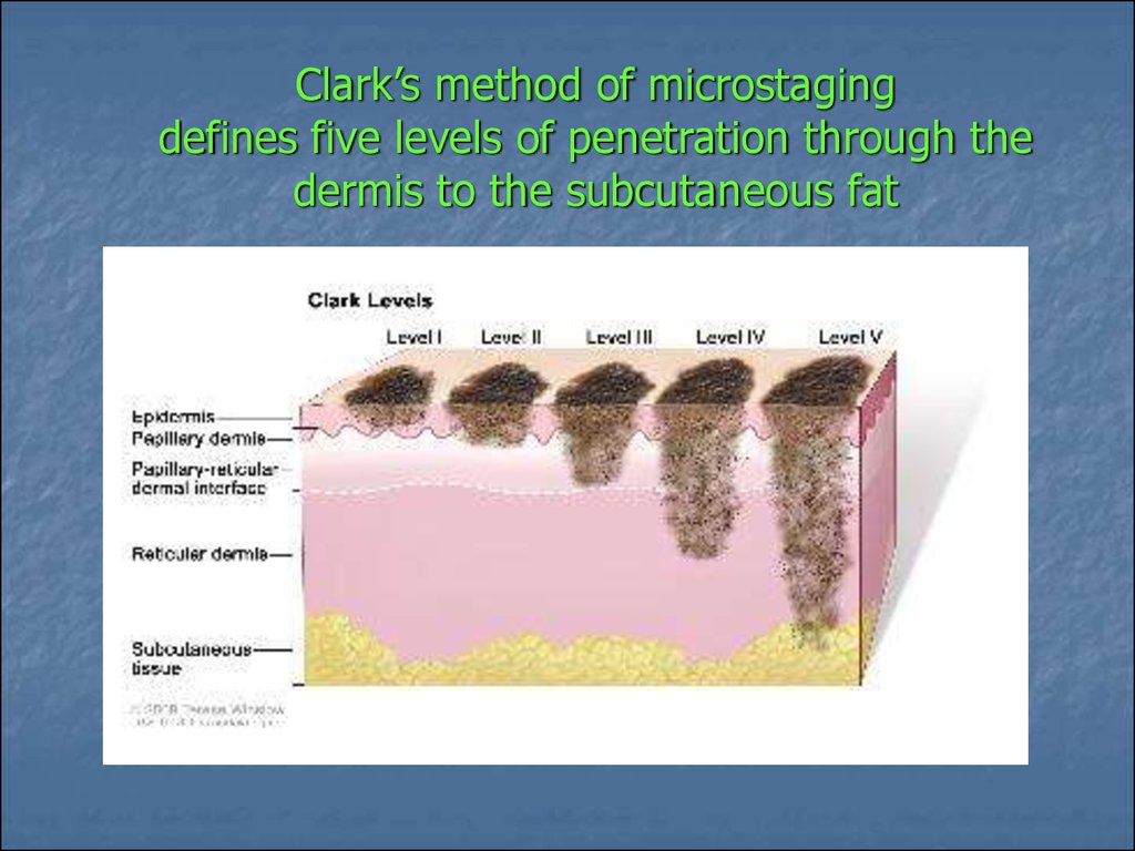 Уровни инвазии меланомы. Уровень инвазии по Кларку и Бреслоу. Уровни инвазии меланомы по Кларку. Уровень инвазии по Кларку 2 что это. Стадии по Кларку.