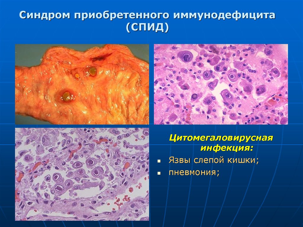 Иммунопатологические процессы презентация