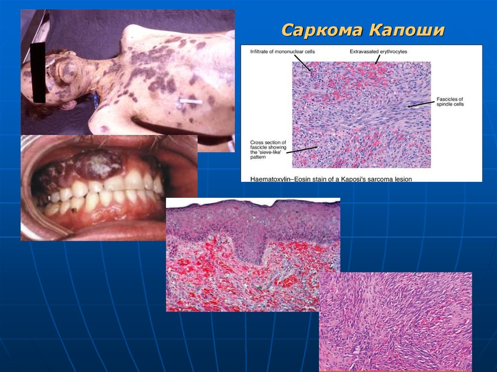 Саркома капоши последняя стадия фото