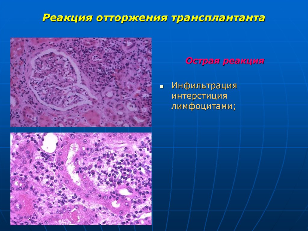 Острая реакция. Отторжение трансплантата патанатомия. Реакция отторжения трансплантата. Реакция отторжения трансплантата патанатомия. Реакция отторжения трансплантата патологическая анатомия.