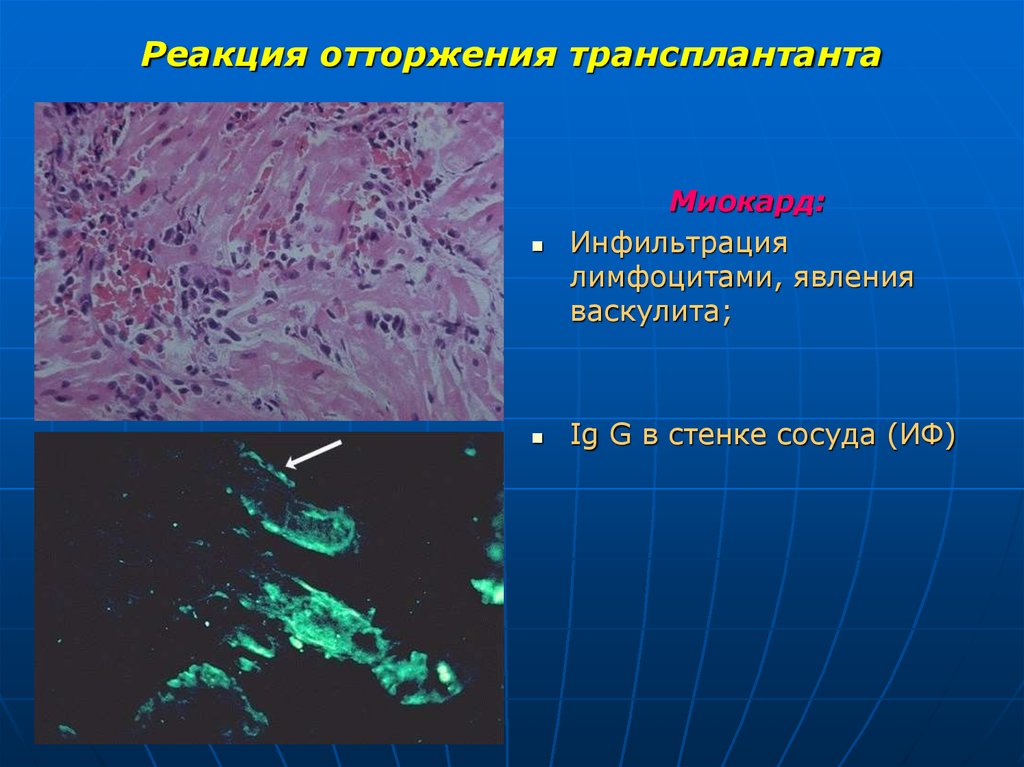 Трансплантант