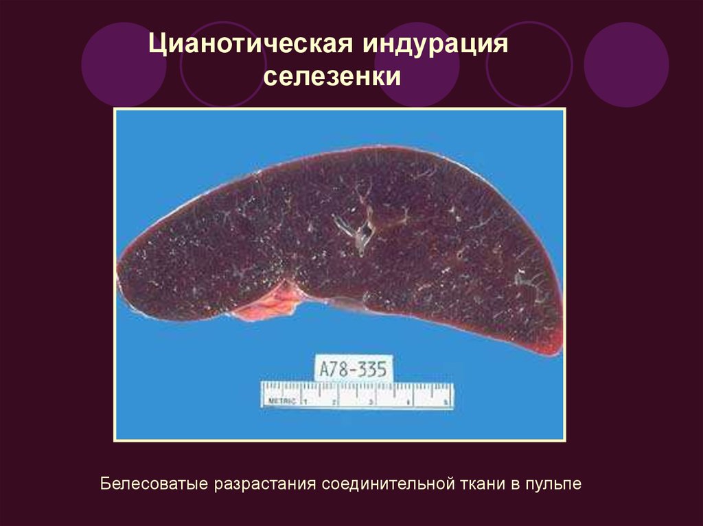 Патология селезенки. Венозное полнокровие селезенки. Цианотическая индурация селезенки. Цианотическая индурация почек гистология. Бурая индурация селезенки.