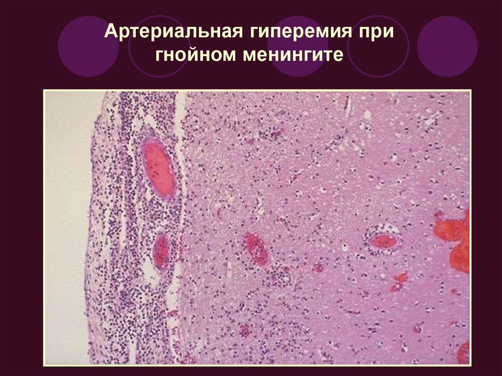 Артериальная гиперемия воспаление. Венозное полнокровие гистология. Полнокровие патанатомия. Артериальное полнокровие микропрепарат. Артериальная гиперемия патологическая анатомия.