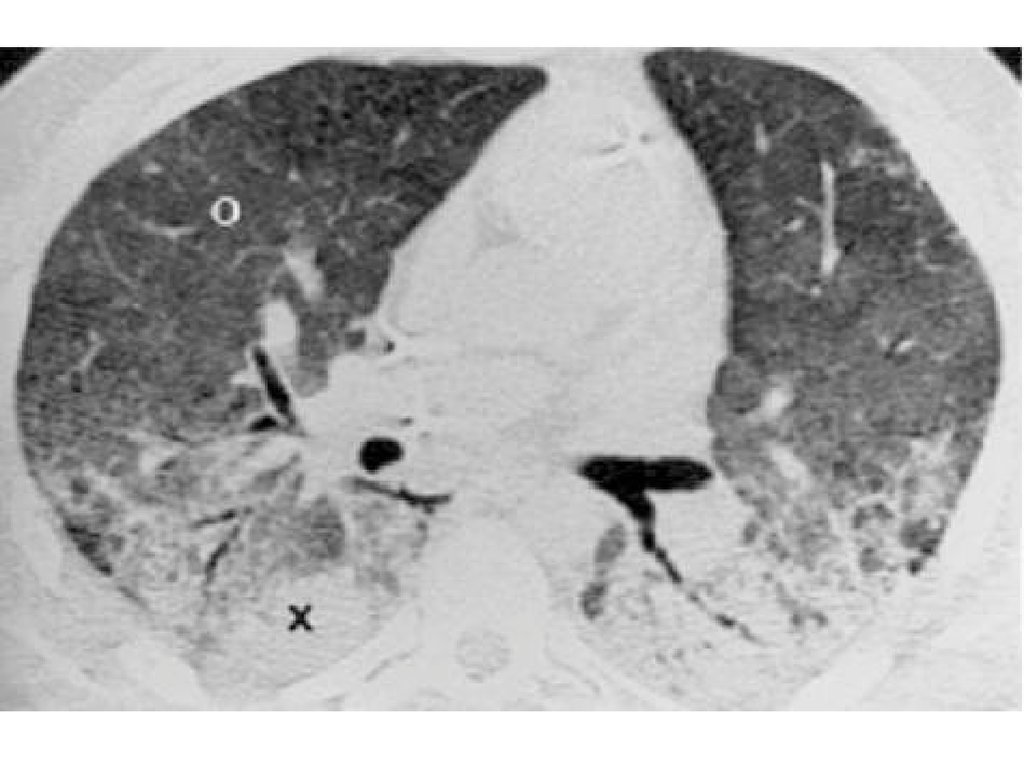 Острое поражение легких. Острый респираторный дистресс-синдром кт. Дистресс синдром легких на кт. Респираторный дистресс синдром на кт.