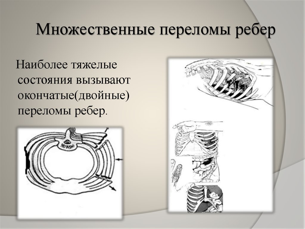 Перелом ребер локальный