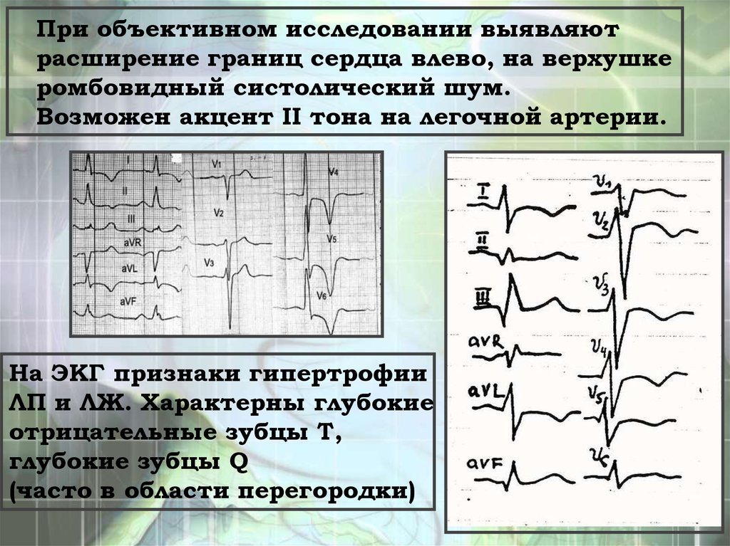 Расширение сердца влево. Акцент 2 тона на легочной артерии. Акцент 2 тона над легочной артерией. Акцент II тона на легочной артерии.