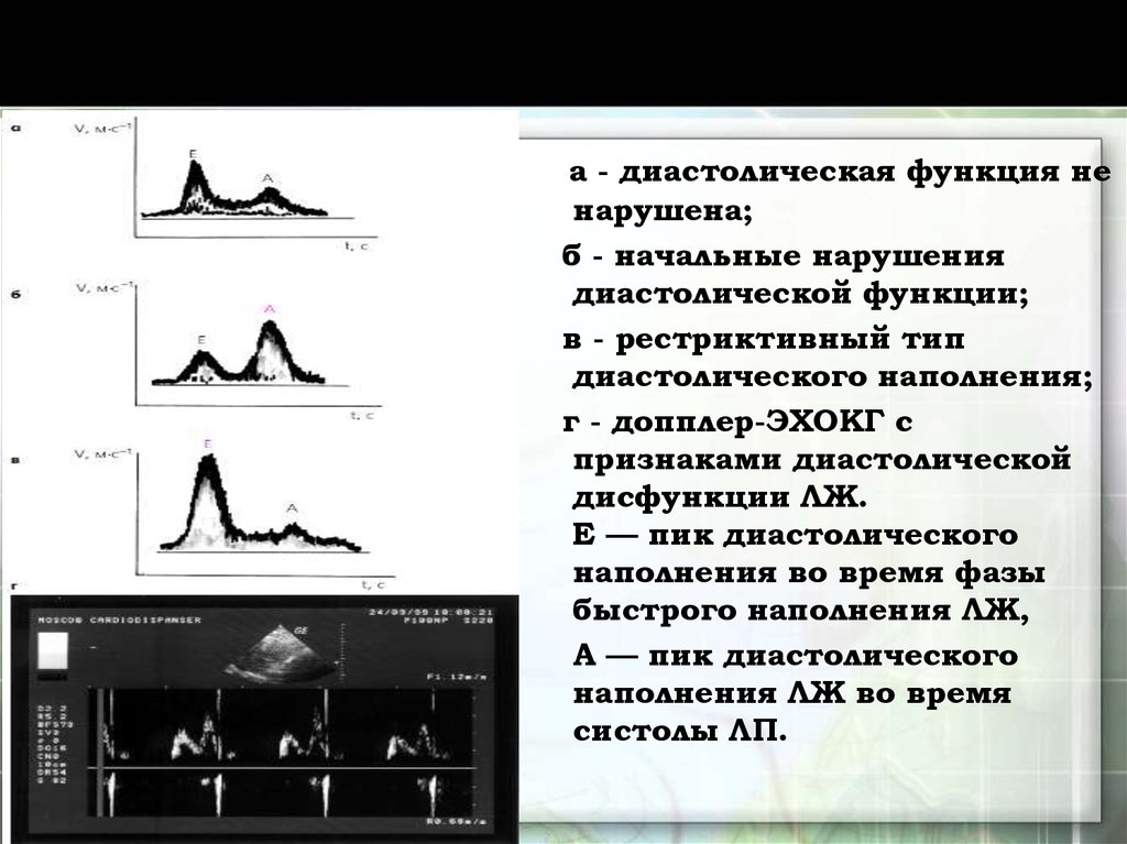 Конечно диастолический. Рестриктивный Тип нарушения диастолической функции. Пик е пик а ЭХОКГ. Диастолическая функция ЭХОКГ. Рестриктивный Тип диастолической дисфункции ЭХОКГ.