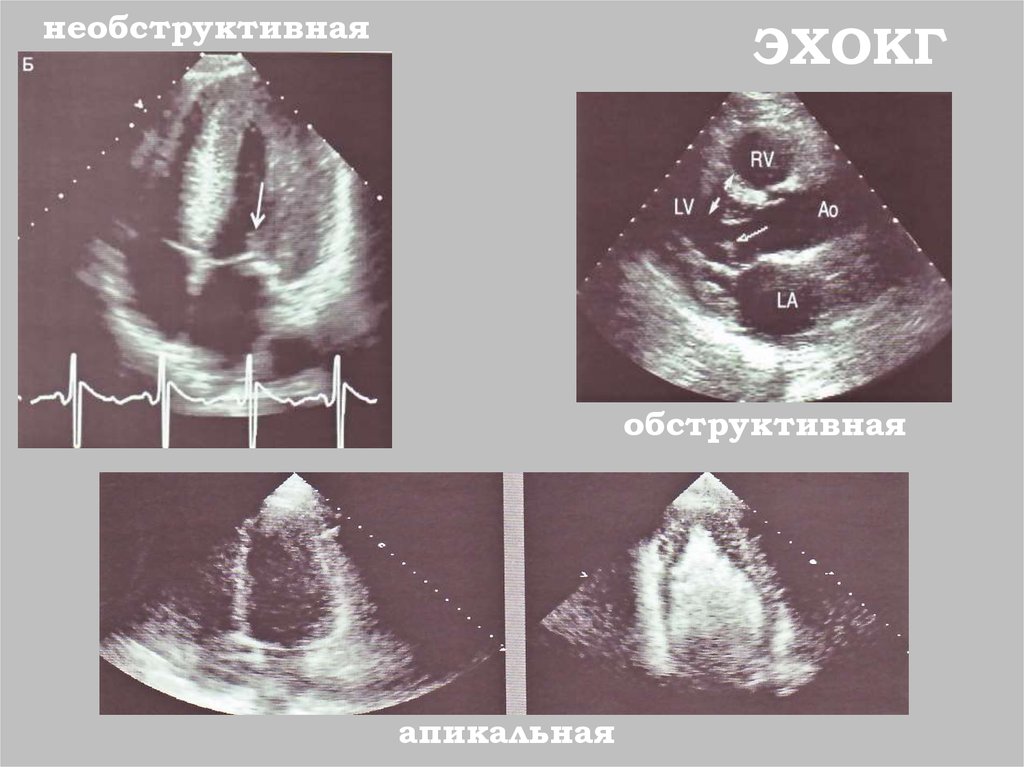 Эхокг это. Обструктивная кардиомиопатия ЭХОКГ. Эндокардит Леффлера на ЭХОКГ. Открытое овальное окно на ЭХОКГ. Эхокардиография синдром Дресслера.