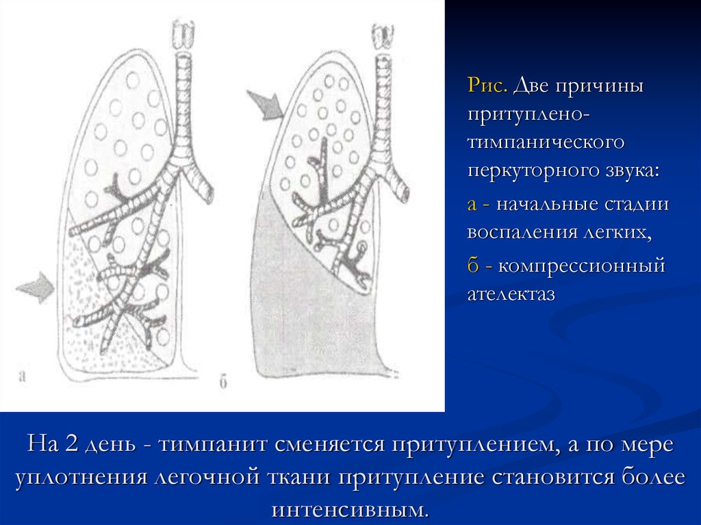 Уплотнение нижней доли легкого. Очаговое уплотнение легочной ткани. Причины уплотнения легочной ткани. Крупозная и очаговая пневмония. Перкуторный звук на начальных стадиях пневмонии.