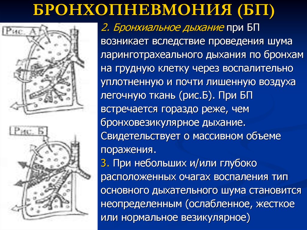 Бронхопневмония у детей. Бронхопневмония презентация. Бронхиальное дыхание пропедевтика. Пневмония бронхиальное дыхание. Бронхо-везикулярное дыхание.