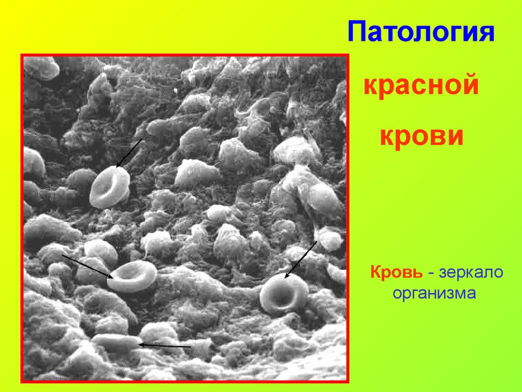 Патология 1. Патология красной крови. Патология крови презентация. Патология красной и белой крови. Патологии красного ростка системы крови.