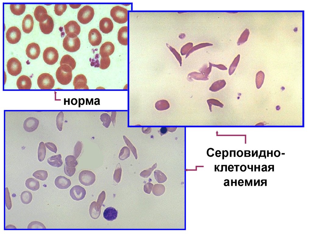 Эритроциты при серповидно клеточной анемии. Серповидноклеточная анемия мазок крови. Серповидноклеточная анемия картина крови. Серповидно клеточная анемия эритроциты. Серповидноклеточная анемия показатели крови.