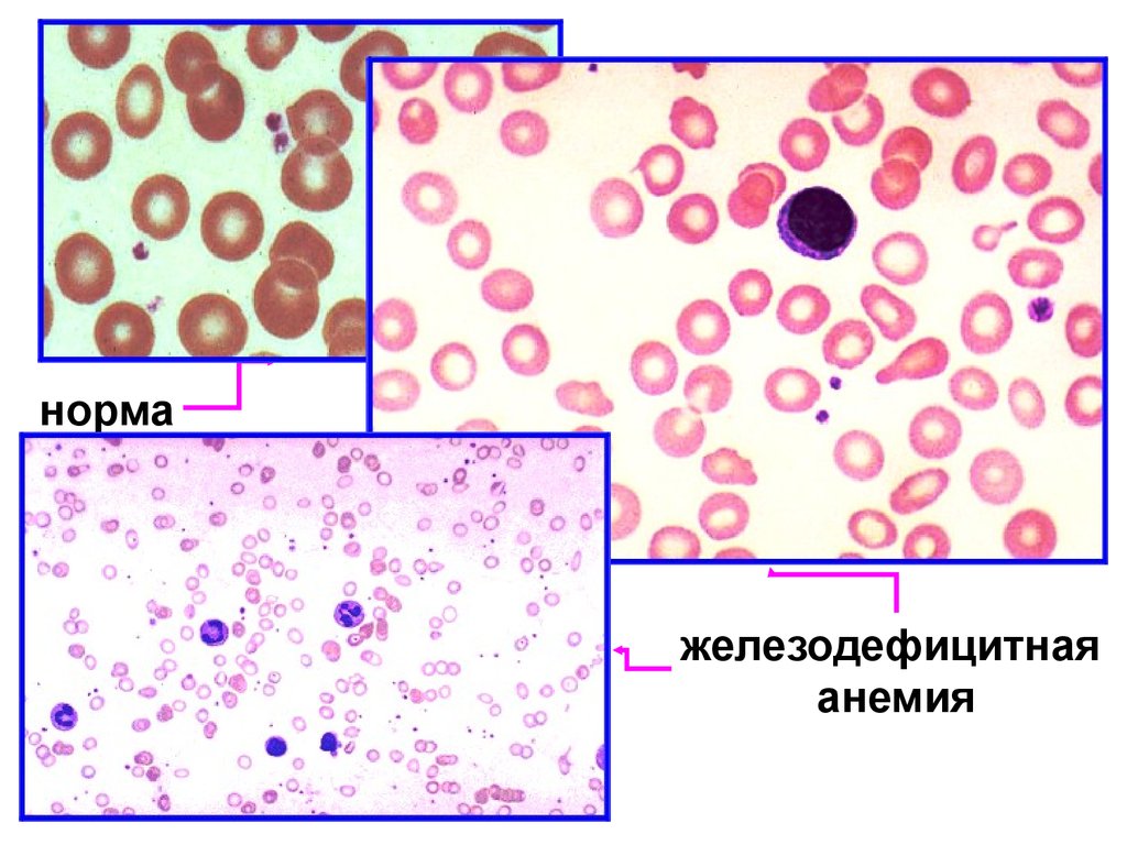Картина периферической крови при железодефицитной анемии