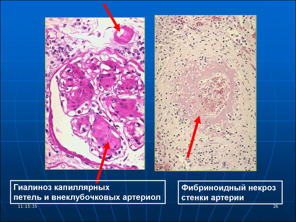 Гиалиноз относится к. Гиалиноз сосудов это патанатомия. Фибриноидный некроз соединительной ткани. Некроз почки макропрепарат. Фибриноидное набухание микропрепарат.
