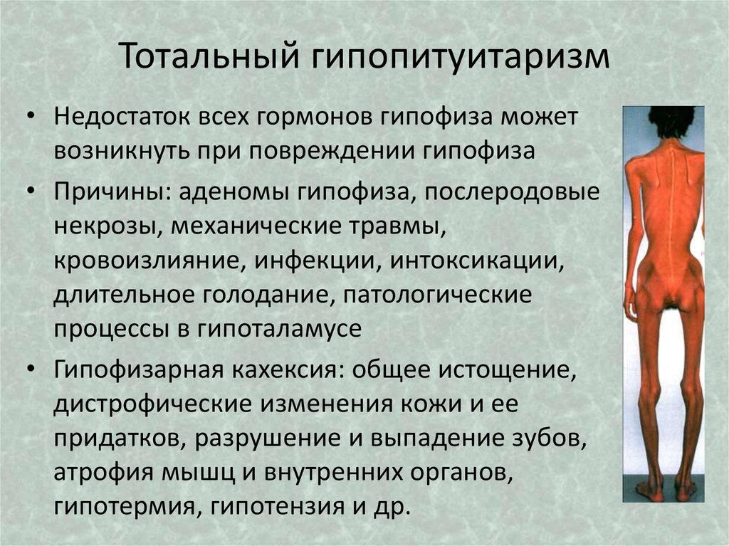 Кахексия симптомы. Гипофизарная кахексия Симмондса. Гипофизарная кахексия болезнь. Гипопитуитаризм (болезнь Симмондса). Заболевания при недостатке гормонов гипофиза.