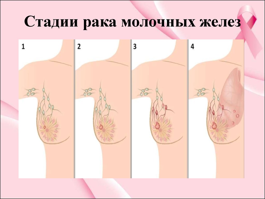 Курсовая Работа На Тему Рак Молочной Железы